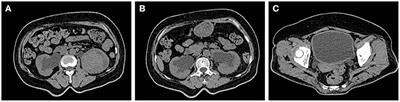 Clinical Analysis of Renal Failure Caused by Malakoplakia: A Case Report and Literature Review